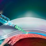 Crean una jeringa inteligente para inyectar en el ojo aguja
