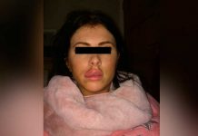 Joven se operó los labios, le explotaron y casi queda ciega inglaterra