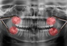 ¿Es cierto que no tener cordales significa ser más evolucionado? muelas de juicio