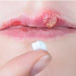 fuegos labiales