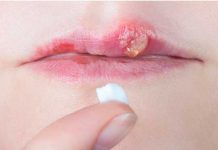 Este virus puedes padecer si te salen ampollas en labios constantemente fuegos labiales