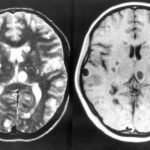 Médicos encuentran larvas en el cerebro de un joven de 18 años india