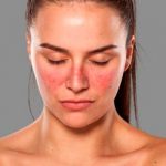 Nuevo medicamento contra el lupus no causará efectos secundarios lupus