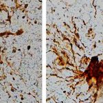 Misteriosa enfermedad cerebral causa seis muertes en el este de Canadá canada