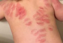 Fue por su hija a la guardería y descubrió que había sido mordida 25 veces