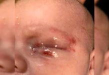 Bebé de 4 semanas de edad contrajo herpes por un beso herpes