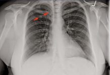 ¿Son cáncer los nódulos pulmonares? Todo esto debes saber sobre ellos nodulos pulmonares