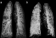 Imágenes muestran los pulmones devastados de pacientes con COVID-19 virus