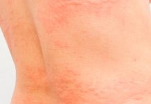 ¿Sin fiebre y con manchas en la piel? puede ser coronavirus afectados