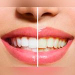 ¿Qué alimentos manchan tus dientes? esmalte