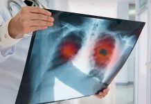 Enfisema pulmonar: El gran desconocido para muchos fumadores enfisema