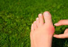 Juanetes: Con este método natural puedes prevenirlos