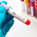 Desarrollan una prueba no invasiva para el cáncer de próstata biopsia