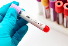 Desarrollan una prueba no invasiva para el cáncer de próstata biopsia