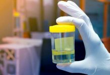 El curioso caso de una mujer que orina alcohol sin haberlo bebido patologia