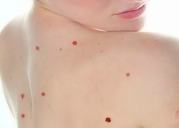 ¿Qué son los lunares rojos que salen en la piel? dermatologos