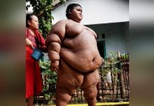 La transformacion del niño mas obeso del mundo obesidad