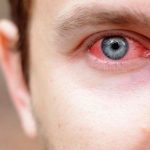 Consejos para evitar la conjuntivitis en verano