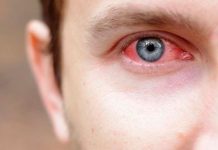 Consejos para evitar la conjuntivitis en verano