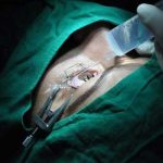 hombre pierde el ojo