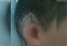 Costa Rica: Accidente en escuela casi le cuesta la oreja a un niño costa rica