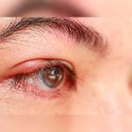 ¿Orzuelos en ojos? Esto son y revelan de tu salud orzuelos