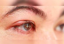 ¿Orzuelos en ojos? Esto son y revelan de tu salud orzuelos