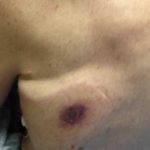 Florida: Otro hombre murió tras infectarse con una bacteria carnívora estados unidos