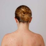 ovarios poliquisticos