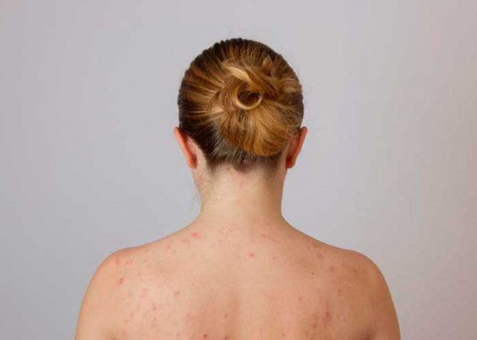 ovarios poliquisticos