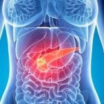 cancer de pancreas