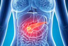 Cáncer de páncreas: conoce los síntomas de esta mortal enfermedad cancer de pancreas