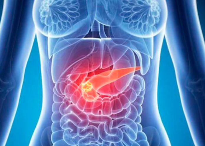 cancer de pancreas