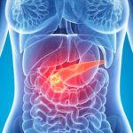 Encuentran pieza clave para tratar el cáncer de páncreas cancer de pancreas