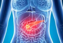 cancer de pancreas