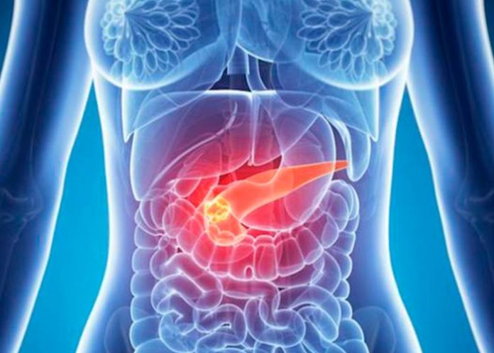cancer de pancreas