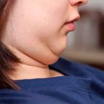 Australia: Se aplica tratamiento para la papada y se le deforma la cara australia