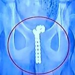 «Por curiosidad» adolescente se metió 70 perlas en el miembro china