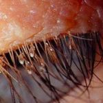 Alerta: Aumentan casos de PIOJOS en pestañas postizas salud