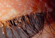 Alerta: Aumentan casos de PIOJOS en pestañas postizas salud