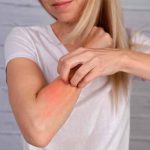 Urticaria: 5 remedios caseros que calman la picazón intensa uticaria