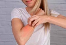 Urticaria: 5 remedios caseros que calman la picazón intensa uticaria
