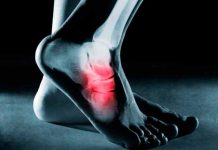 fascitis plantar