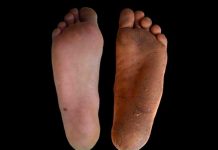 Los pies descalzos con callos, mejores para caminar que los zapatos pies descalzos