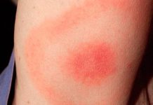Vacuna para enfermedad trasmitida por garrapatas podría fabricarse pronto lyme