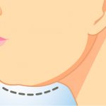 ¿Tienes mucha papada? ¡Ten cuidado! Podría ser una enfermedad papada