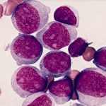leucemia