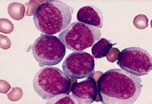 El 90 % de pacientes con leucemia mieloide mueren antes del tratamiento leucemia