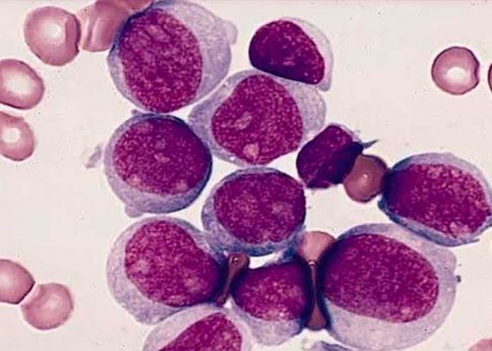 portada_9ZHiEk2 leucemia