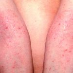 Dermatitis atópica padecerla genera pensamientos suicidas dermatitis atopica